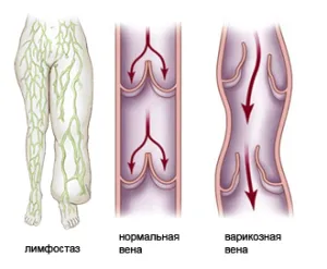 як лікувати лімфостаз