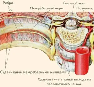 Міжреберна невралгія як лікувати невралгію м'язів