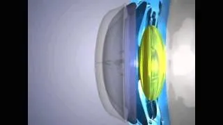 як лікувати короткозорість високого ступеня