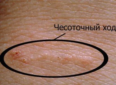 ліки короста мазь без запаху проти засіб