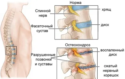 як лікувати шийний остеохондроз 3 ступеня