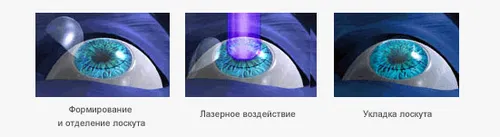 астигматизм