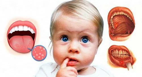 як лікувати стоматит маслом обліпихи