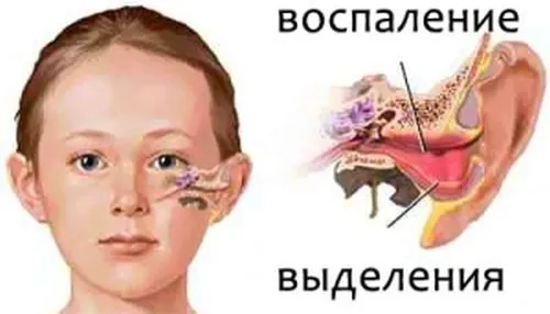 як лікувати гострий отит
