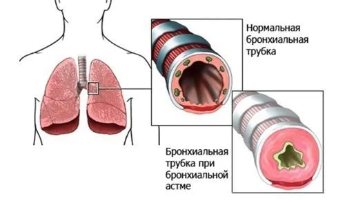 якими ліками лікувати бронхіальну астму