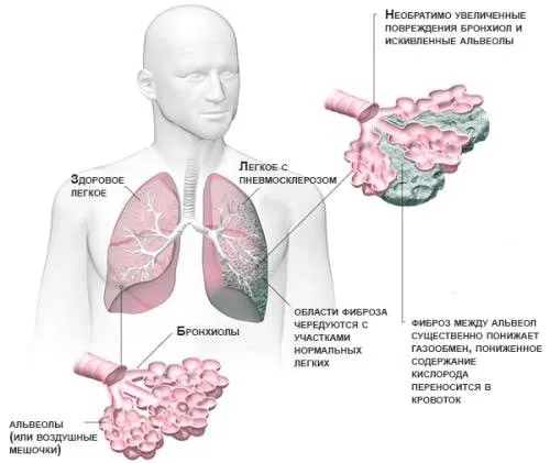 лікувати фіброз легенів