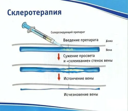 терапії