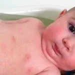 лікуватися чи дерматит