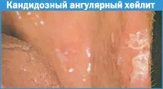 як лікувати кандидоз при вич