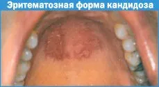 спід в порожнині рота. кандидоз.