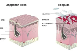 все про псоріазі