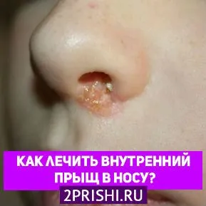 як вилікувати прищі в носі