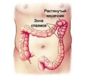 лікувати роздратований кишечник