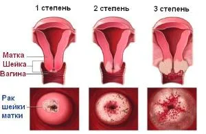 як лікувати рак шийки матки 3 ступеня