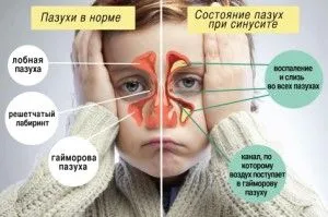 Синусит: симптоми і лікування у дітей як лікують синусит у дітей
