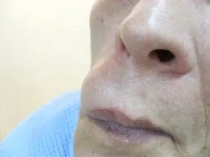 як лікувати жировик на щоці