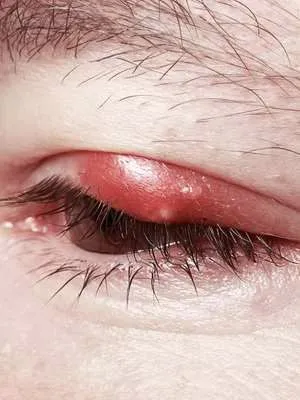 як лікувати глисти в очах