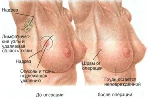 як лікувати рак молочної залози 3 стадії