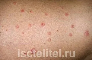 Псоріаз - домашнє лікування як лікувати ерітродерміческій псоріаз