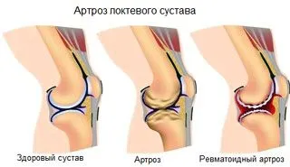 як лікувати ліктьовий артроз