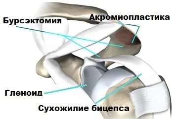 Тендиніт сухожилля біцепса: причини, симптоми, діагностика, лікування тендиніт головки біцепса сухожилля плече лікування