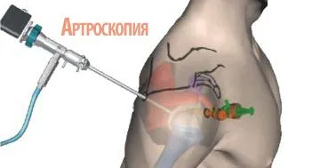 лікувати забій плечового суглоба