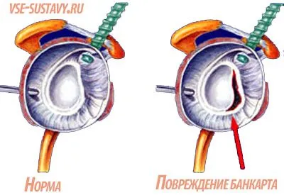 лікувати забій плечового суглоба