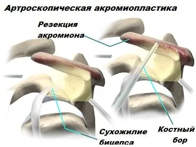 Тендиніт сухожилля біцепса: причини, симптоми, діагностика, лікування як лікувати розтягнення біцепса