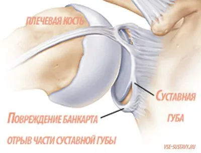 лікувати забій плечового суглоба