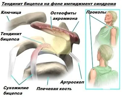 Тендиніт сухожилля біцепса: причини, симптоми, діагностика, лікування тендиніт головки біцепса сухожилля плече лікування