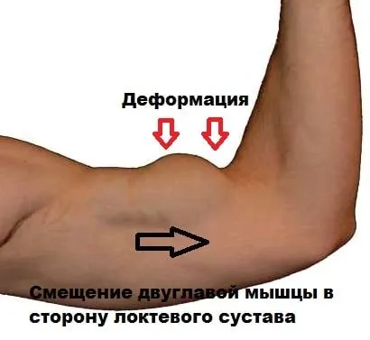 Тендиніт сухожилля біцепса: причини, симптоми, діагностика, лікування як лікувати розтягнення біцепса