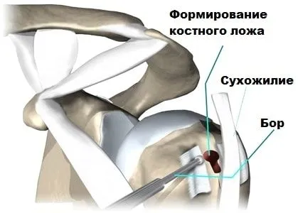 Тендиніт сухожилля біцепса: причини, симптоми, діагностика, лікування тендиніт головки біцепса сухожилля плече лікування