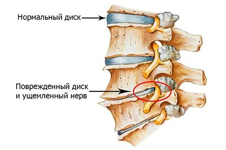 зірвати спину лікування