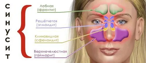 як ефективно лікувати синусит