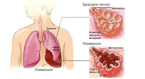 ознаки пневмонії у дитини