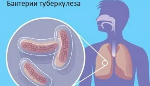 як лікувати туберкулема легких