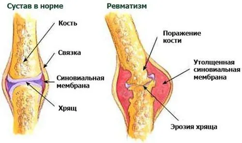 як лікувати ревматизм у дітей