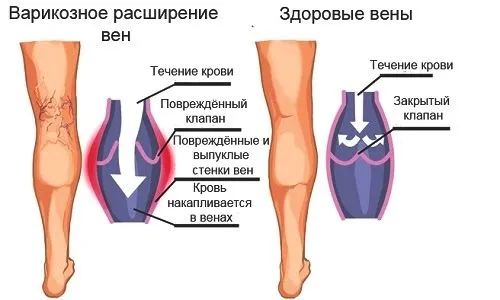 як лікувати варикоз глибоких вен