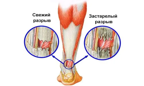 як лікувати розрив ахіллового сухожилля
