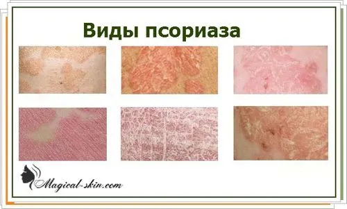 Псоріаз на обличчі: як лікувати особа псоріаз фото лікування