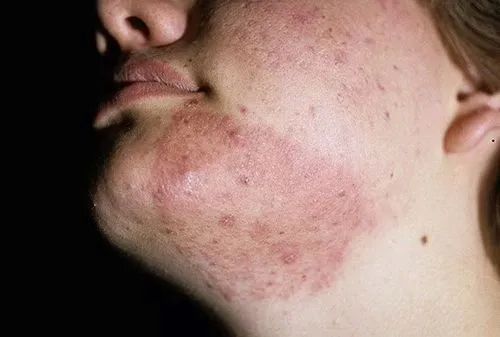 як лікувати псоріаз на обличчі