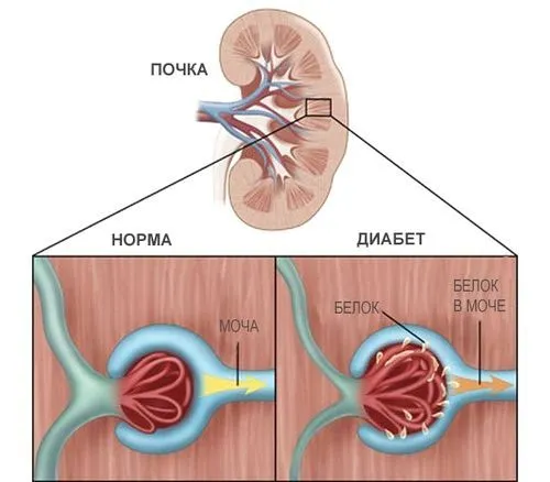 як лікувати нирки при цукровому діабеті