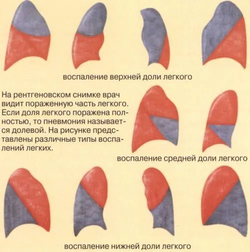 пневмонія у дітей до року