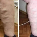 Внутрішній варикоз: види, симптоми, лікування захворювання ознаки
