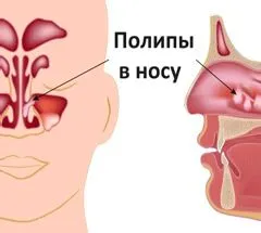 Хронічний поліпозний гайморит гнійний кістозний хронічний поліпозний гайморит лікування