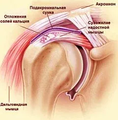 як лікувати артроз на ранній стадії