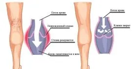Внутрішній варикоз: види, симптоми, лікування захворювання симптоми