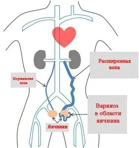 як лікувати варикоз органів малого таза