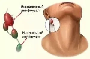 як лікувати лімфовузли підщелепні