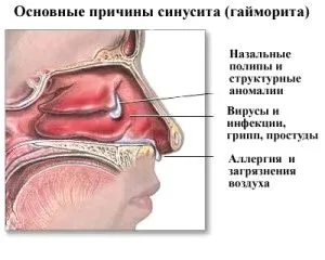 як вилікувати нежить якщо він не проходить